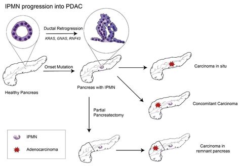 Intraductal Papillary Mucinous Neoplasm Symptoms