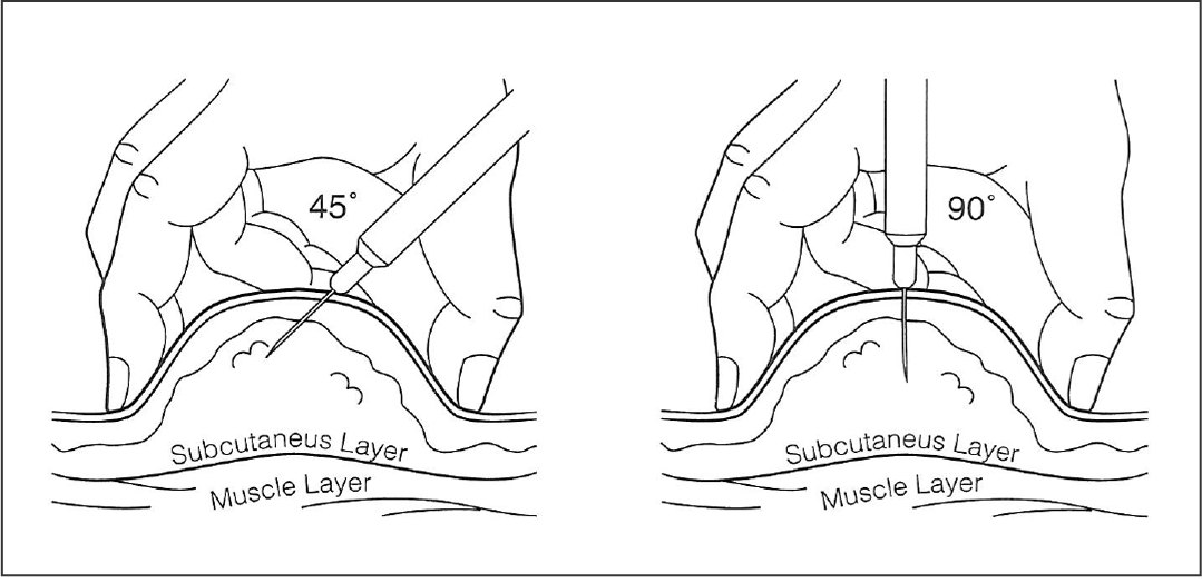 Subq Injection Sites Guide